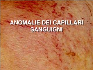 ANOMALIE DEI CAPILLARI SANGUIGNI