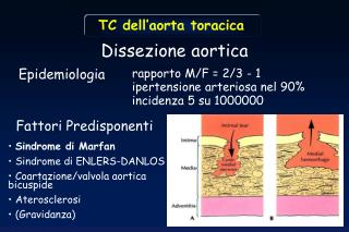 Dissezione aortica