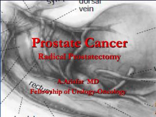 Prostate Cancer Radical Prostatectomy