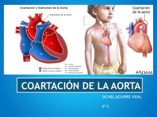 COARTACIÓN DE LA AORTA