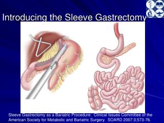 Introducing the Sleeve Gastrectomy