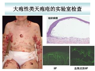 大疱性类天疱疮的实验室检查