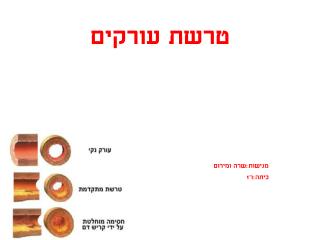 טרשת עורקים