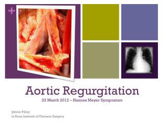 Aortic Regurgitation 23 March 2012 – Hannes Meyer Symposium