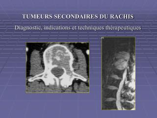 TUMEURS SECONDAIRES DU RACHIS Diagnostic, indications et techniques thérapeutiques