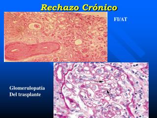 Rechazo Crónico