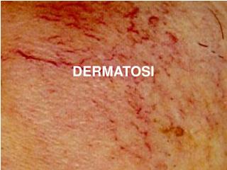 DERMATOSI