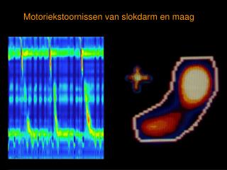 Motoriekstoornissen van slokdarm en maag