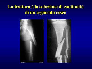 La frattura è la soluzione di continuità di un segmento osseo