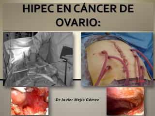 HIPEC EN CÁNCER DE OVARIO: