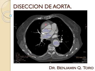 DISECCION DE AORTA.