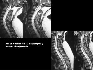 RM en secuencia T2 sagital pre y postop siringomielia