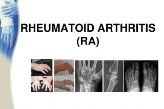 RHEUMATOID ARTHRITIS (RA)