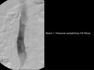 Resim 1: İnfrarenal yerleştirilmiş IVK filtresi