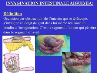 INVAGINATION INTESTINALE AIGUE(IIA) Définition