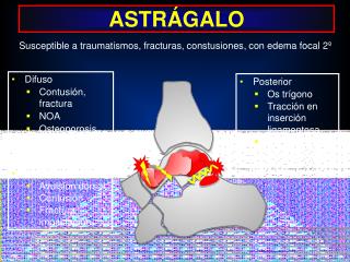 D ifuso C ontusión, fractura NOA Osteoporosis transitoria