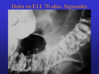 Dolor en F.I.I. 70 años. Sigmoides