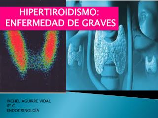 HIPERTIROIDISMO: ENFERMEDAD DE GRAVES