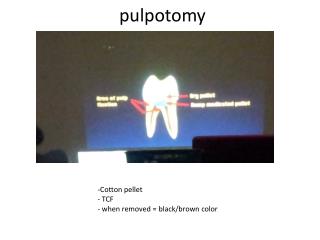 pulpotomy