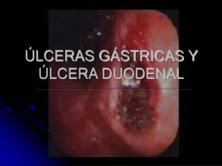 ÚLCERAS GÁSTRICAS Y ÚLCERA DUODENAL