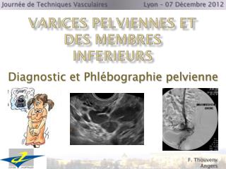 Varices pelviennes et des membres inferieurs