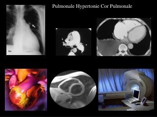 Pulmonale Hypertonie Cor Pulmonale