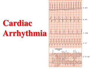 Cardiac Arrhythmia