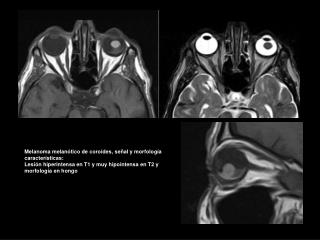 Melanoma melanótico de coroides, señal y morfología características: