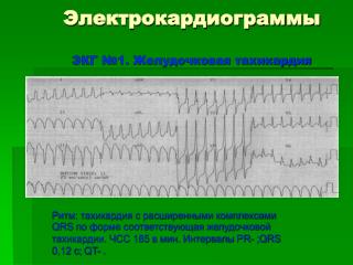 Электрокардиограммы ЭКГ №1. Желудочковая тахикардия