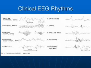 Clinical EEG Rhythms