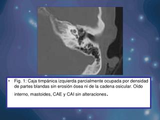 Fig. 10c: colesteatoma del ático del oído medio derecho.