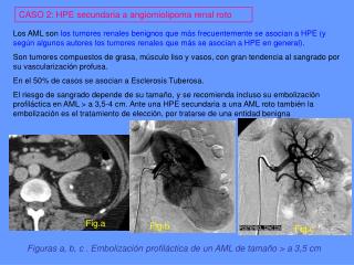 CASO 2: HPE secundaria a angiomiolipoma renal roto