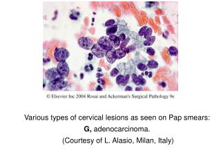 Various types of cervical lesions as seen on Pap smears: G, adenocarcinoma.
