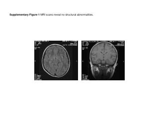 Supplementary Figure 1 MRI scans reveal no structural abnormalities.