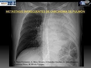 METÁSTASIS INFRECUENTES DE CARCINOMA DE PULMÓN