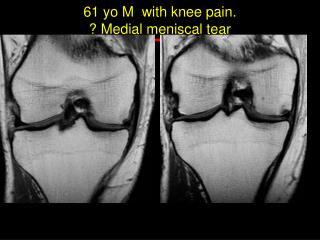 61 yo M with knee pain. ? Medial meniscal tear