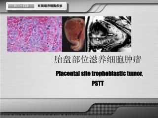 胎盘部位滋养细胞肿瘤 Placental site trophoblastic tumor, PSTT