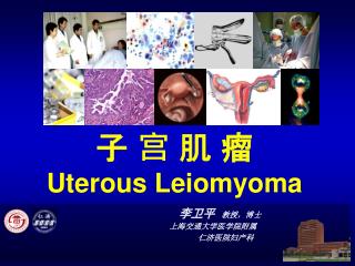 子 宫 肌 瘤 Uterous Leiomyoma