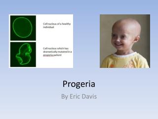 Progeria