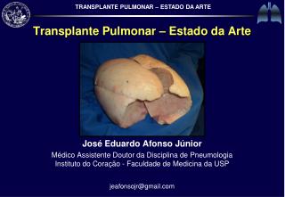 Transplante Pulmonar – Estado da Arte