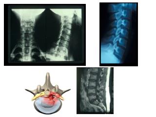 0 = 	pas de plainte, examen normal I = 	cervicalgie, pas de douleur à la palpation