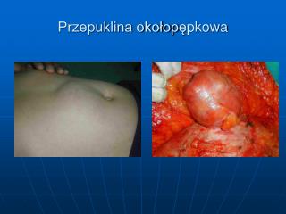 Przepuklina okołop ę pkowa