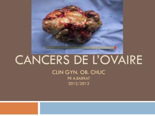 CANCERs DE L’OVAIRE clin gyn . ob . CHUC Pr A.BARKAT 2012/2013