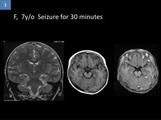 F, 7y/o Seizure for 30 minutes