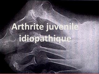 Arthrite juvenile idiopathique