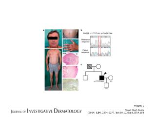 Smail Hadj-Rabia (2014) 134 , 2274-2277. doi:10.1038/jid.2014.158