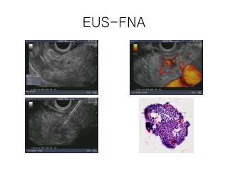 EUS-FNA