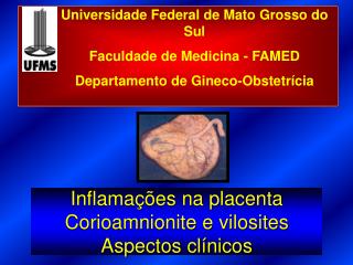 Inflamações na placenta Corioamnionite e vilosites Aspectos clínicos