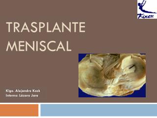 Trasplante meniscal