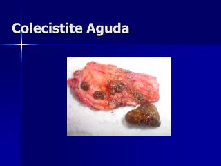 Colecistite Aguda